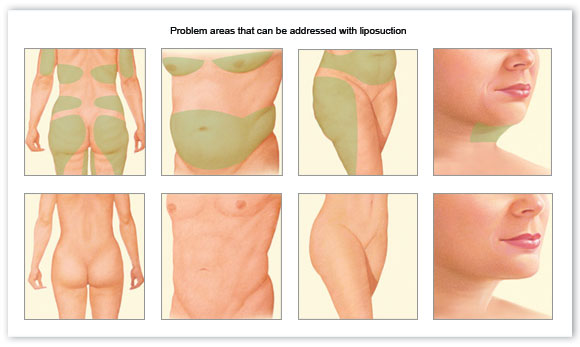 liposuction cyprus.jpg